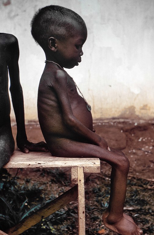 Sitzendes Kind mit den typischen Symptomen der Krankheit Kwashiorkor. Das Foto entstand in einem nigerianischen Flüchtlingslager während des Biafra-Krieges, wo viele Kinder in Folge von Unterernährung an Kwashiorkor litten. Dr. Lyle Conrad, Centers for Disease Control and Prevention, Atlanta, Georgia, USA<br />Public Health Image Library (PHIL); ID: 6901 [Public domain]